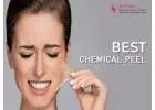 Discover Radiant Skin with Best Chemical Peel Treatments in Bangalore