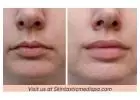Luscious Lips Awaits with Lip Fillers
