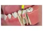 Get Competitive Cost for Root Canal Treatment in India