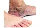Understanding the Causes of Purple Skin on Legs