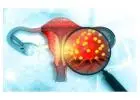 Best Surgeon for Endometrial Cancer in Ahmedabad