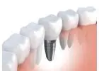 Cost Effective Dental Implants in India