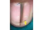 Navigating Nail Health: The Role of Onychoscopy in Diagnosis and Treatment