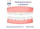 Teeth Braces Cost in Coimbatore | Affordable Braces Coimbatore