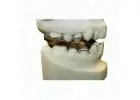 China Orthodontic Lab Offers Superior Twin Block Appliances for Effective Orthodontic Treatment
