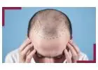 best hair transplant clinic in hyderabad