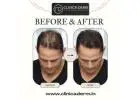 The Premier Choice for Seamless Hair Transplantation Services in Hyderabad