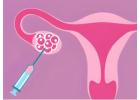 ICSI Treatment - IntraCytoplasmic Sperm Injection | Aeva Clinic