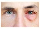 Eye Allergy Treatment in Delhi