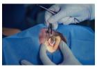Cataract specialist in Saket