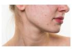 Acne Vulgaris treatment in Delhi Get Clear and Glowing Skin
