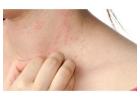 Best urticaria treatment in Delhi