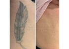 Expert Laser Tattoo Removal in Brisbane Safe and Affordable