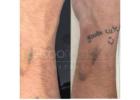 Affordable and Professional Eyebrow Tattoo Removal in Brisbane