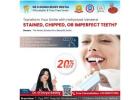 Best Dental Veneers for a Hollywood Smile Makeover in Nellore