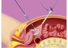 Vasectomy Reversal Procedure | AEVA Fertility - Ashok Nagar