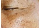 Transform Your Skin with Premier Skin Clinic in Cardiff for Advanced Treatments by Vale Laser