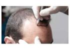 Hair Transplant Treatment
