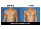 Sculpt a Defined Chest with Pec Implants in Los Angeles