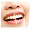 Teeth Whitening at Discounted Rates – Limited Time in Ahmedabad!
