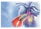 Angioplasty Hospitals in Raipur