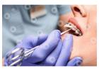 Best Teeth Cleaning in Dubai | Teeth Cleaning Service