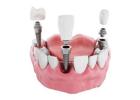 Discover Dental Implants In Melbourne At Dr Helen’s Studio