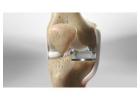 Get Back on Your Feet with Partial Knee Replacement Surgery