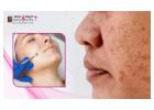 Best Open Pores Treatment in Bangalore