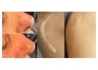 What is a scar camouflage tattoo and how does it work?