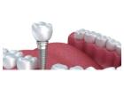 How much do dental implants cost in Delhi?