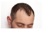 Exosome Therapy for Hair Restoration at Enhancement Institute