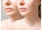 How Dermal Fillers Enhance the Face and Neck