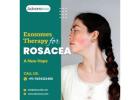 Exosomes Therapy for Rosacea: A New Hope
