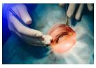 Eyelid Surgery (Blepharoplasty) – Restore a Refreshed Look