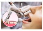 Pleasant Dental’s Expert Wisdom Tooth Extraction Services