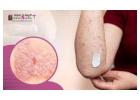 Effective Skin Psoriasis Treatment in Bangalore