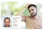 Best Premium Hair Patch in Delhi - DHI India