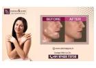 Advanced Vitiligo Treatment in Bangalore