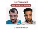 Hair Transplant In India