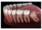 Wisdom Tooth Extraction Made Easy – Expert Care at Pleasant Dental