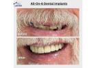 Looking for Full-Mouth Restoration? Explore All-on-6 Dental Implants in Delhi
