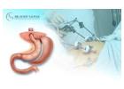 Expert General Surgery in Whitefield by DrSumitObesityCare