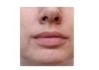 Discover Expert Botox Treatments in Cardiff for a Youthful Look at Vale Laser
