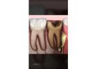 Prevent Tooth Decay with Strong, Natural-Looking Fillings