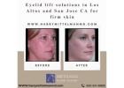 Eyelid lift options in Los Altos and San Jose CA when skin is tight