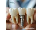 Discover Best Quality Dental Implants Brands in Guatemala