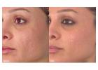 Erbium Laser Skin Resurfacing Clermont