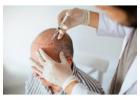 Hair Transplant