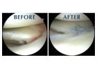 Exceptional Care for Torn Meniscus Repair